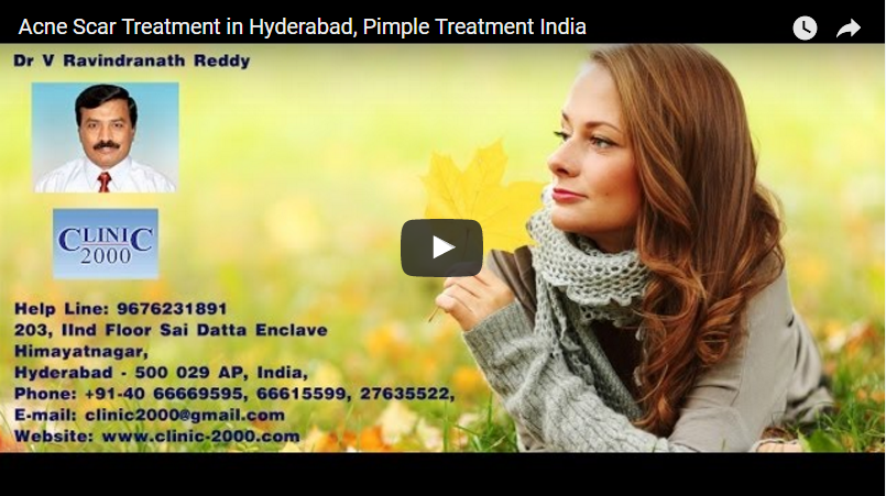 Acne Scar Treatment in Hyderabad, Pimple Treatment India