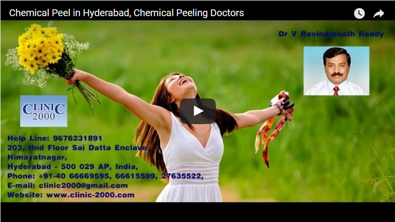 Chemical Peel in Hyderabad, Chemical Peeling Doctors