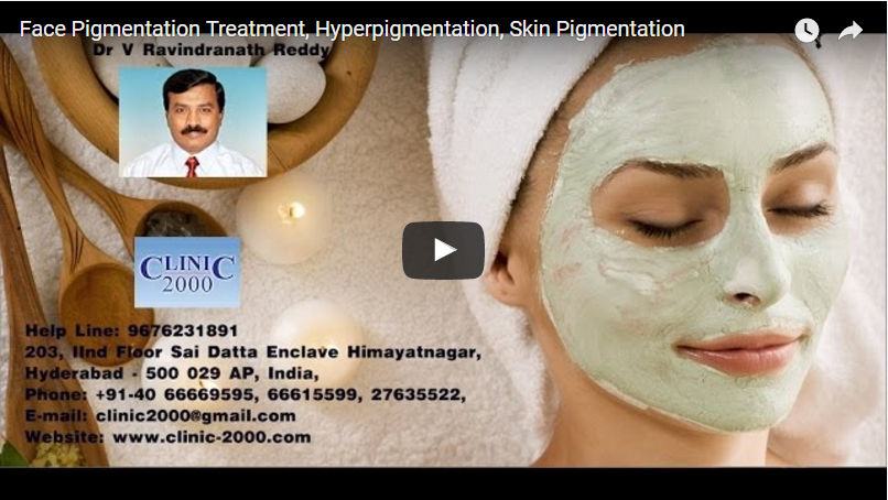 Face Pigmentation Treatment, Hyperpigmentation, Skin Pigmentation