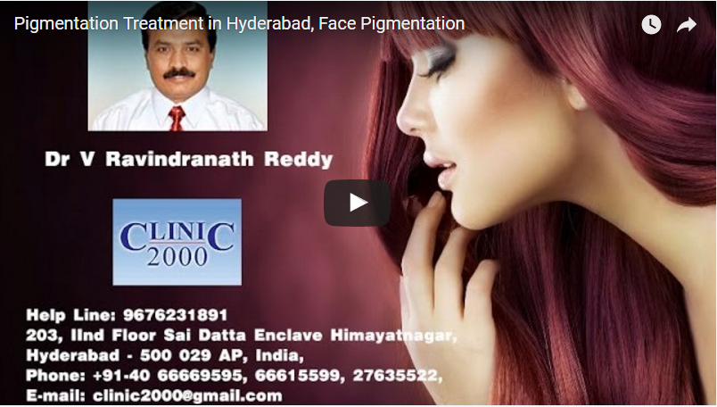 Pigmentation Treatment in Hyderabad, Face Pigmentation