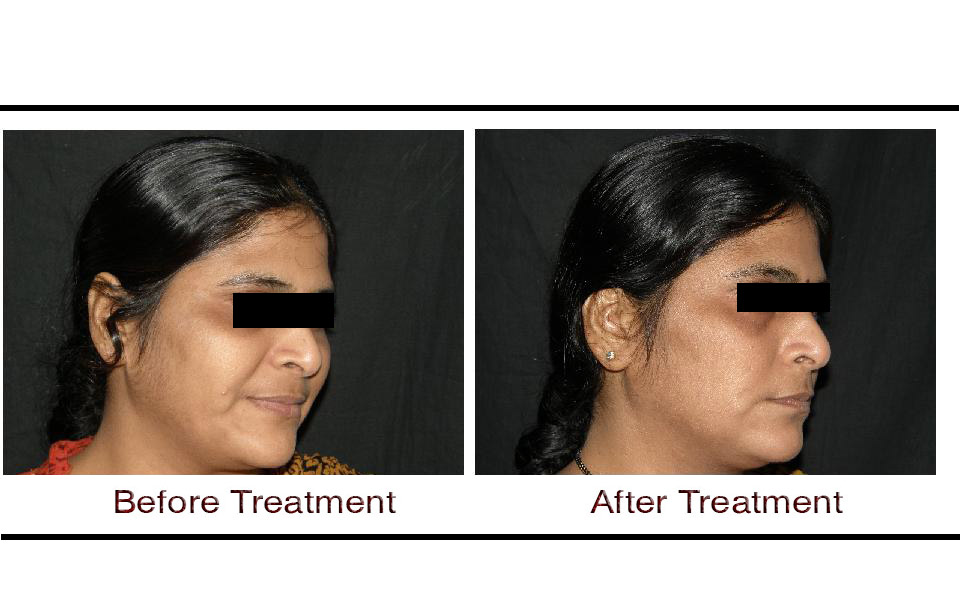 Skin Treatments in Hyderabad