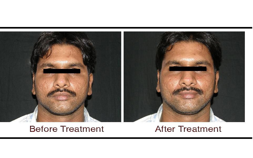 E Plus Laser Treatment in Hyderabad