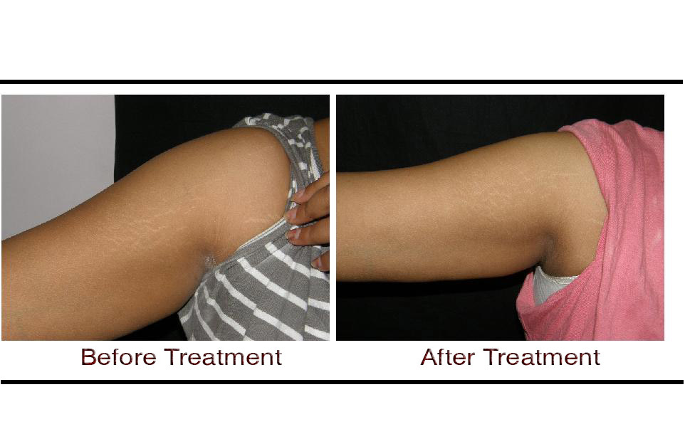 Skin Rejuvenation laser treatment in Hyderabad