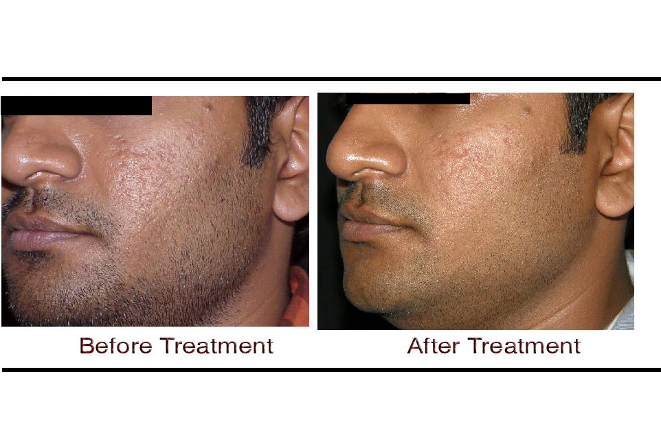 Skin Pigmentation Treatment in Hyderabad