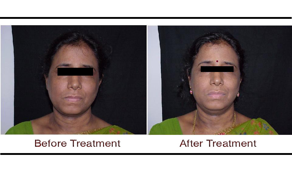 Thermage before and after face