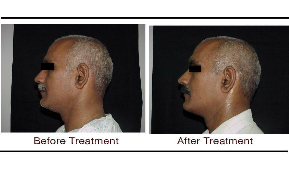 Thermage Skin Tightening Laser Treatment