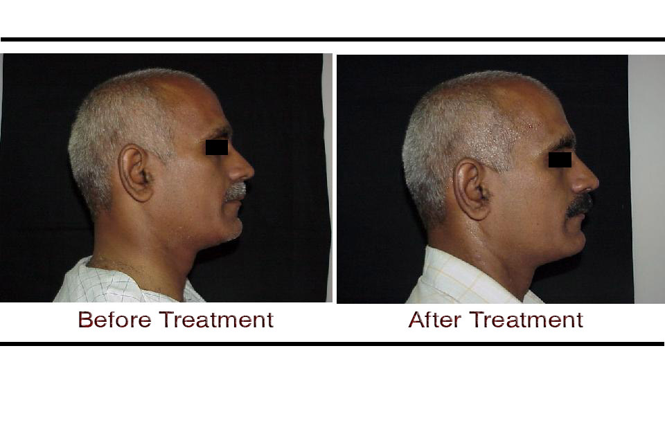 Thermage CPT Non-Surgical Skin Tightening