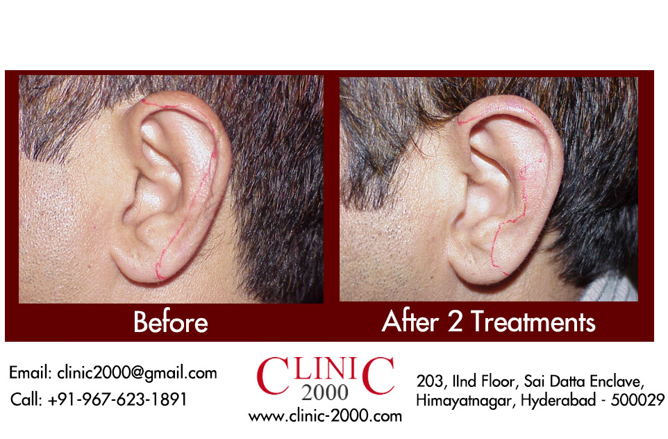 Ear Hair Permanent Removal