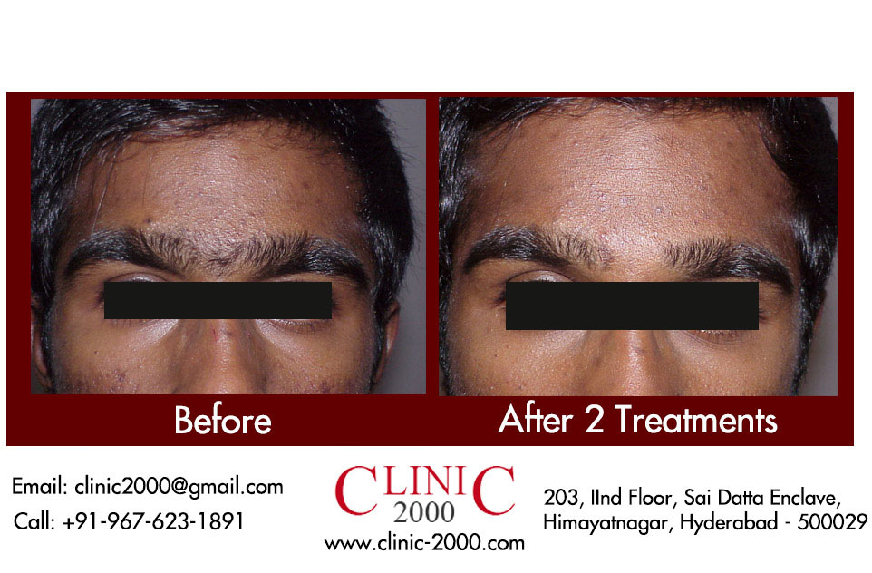 Permanent Hair Removal on Eyebrows