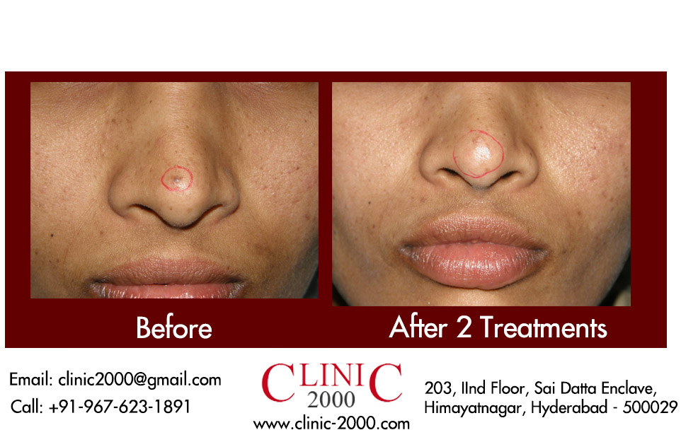 Laser Mole Removal Treatment in Hyderabad