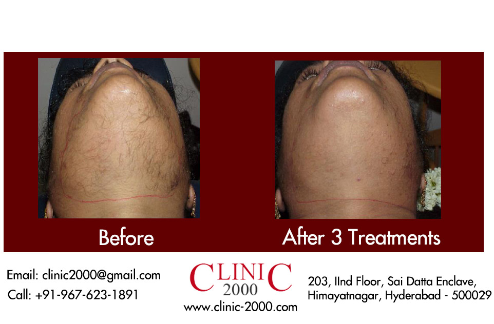 Laser Hair Removal Treatment Before and After Pictures