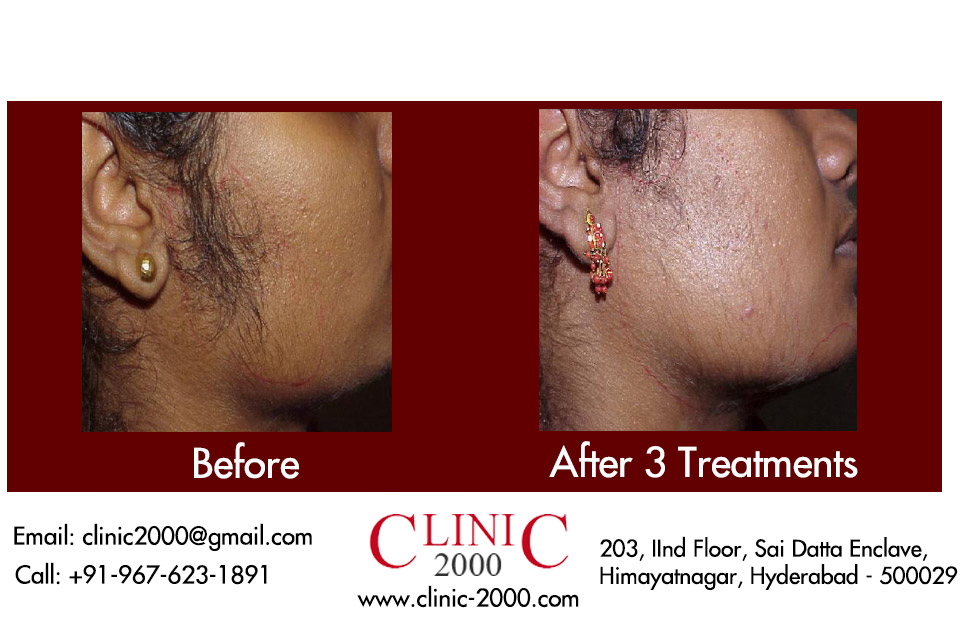 Permanent Laser Hair Reduction in Hyderabad