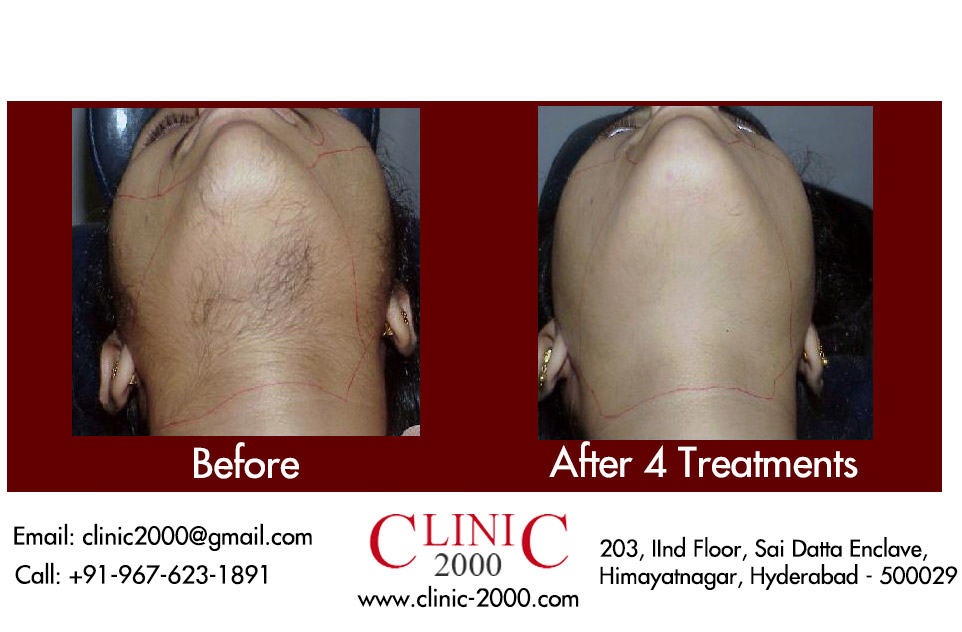 Permanent Hair Removal Treatment in Hyderabad