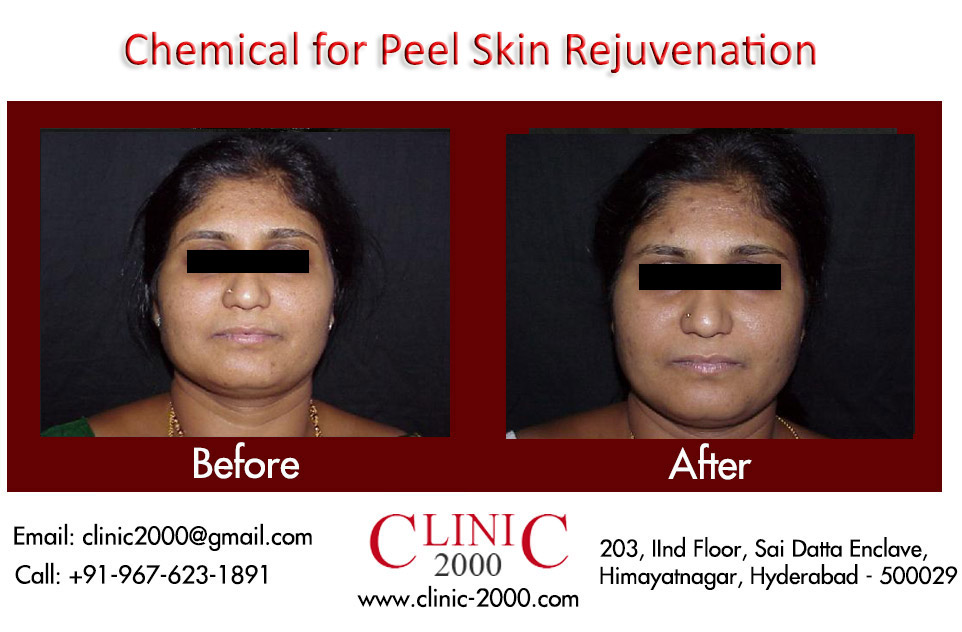 Chemical Skin peel treatments at Clinic@2000