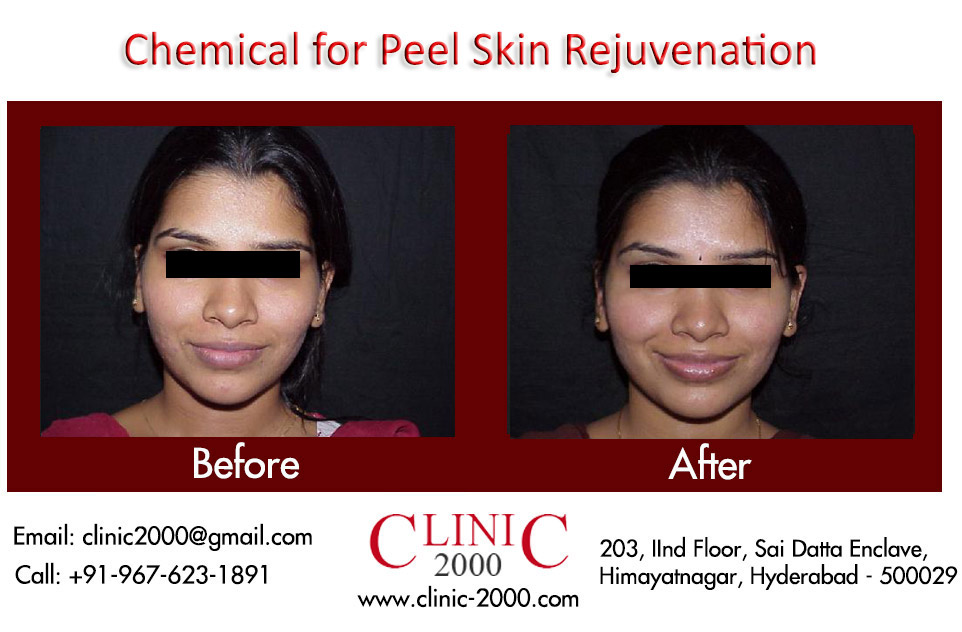Best Skin peel Treatment in Hyderabad