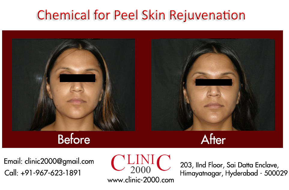 Chemical for peel Skin Rejuvenation treatment in Hyderabad