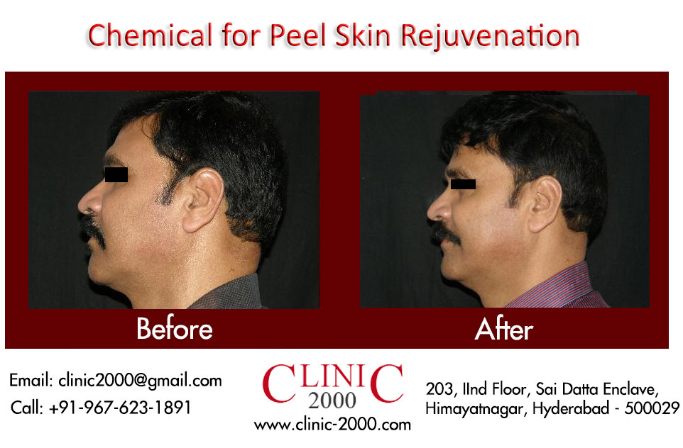 Get Younger looking skin with Skin Peel Treatment