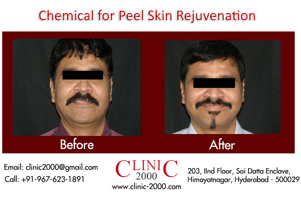 Laser & Skin Rejuvenation Clinic in Hyderabad