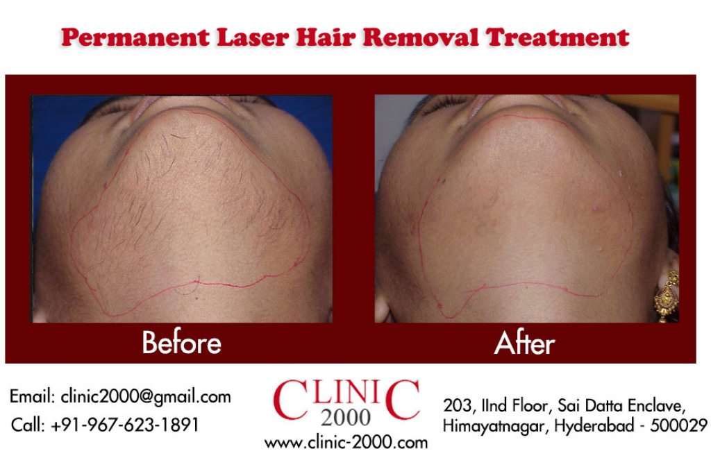 Laser Chin Hair Removal