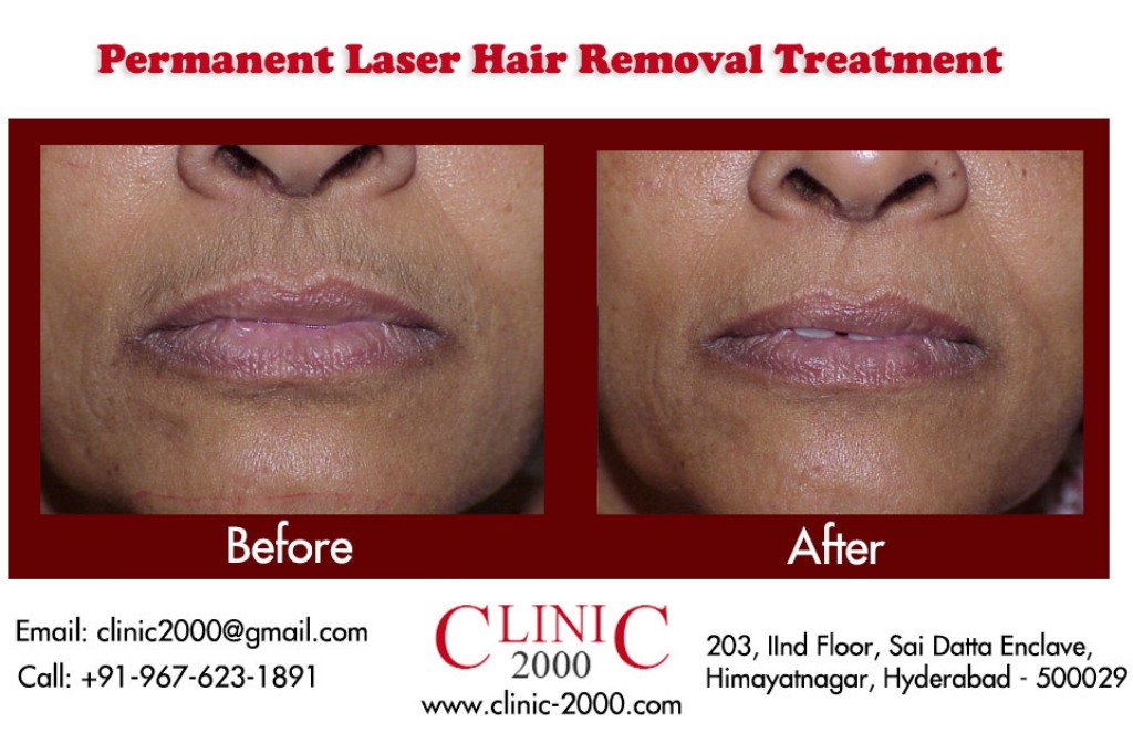 Laser treatment for upperlip hair removal