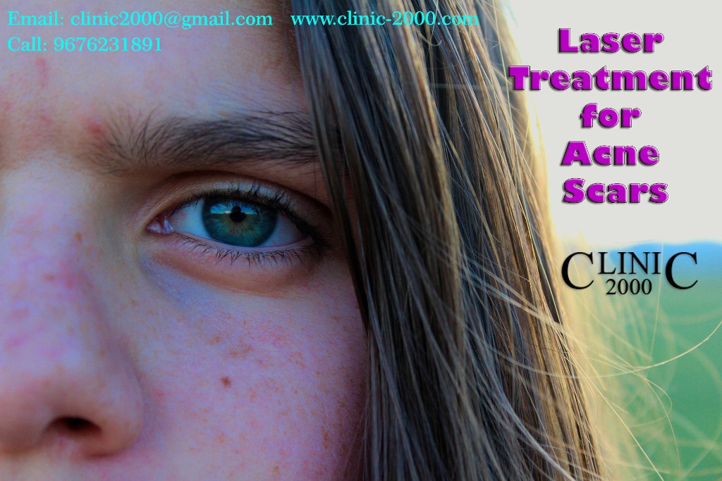 Best Acne Treatment in Hyderabad