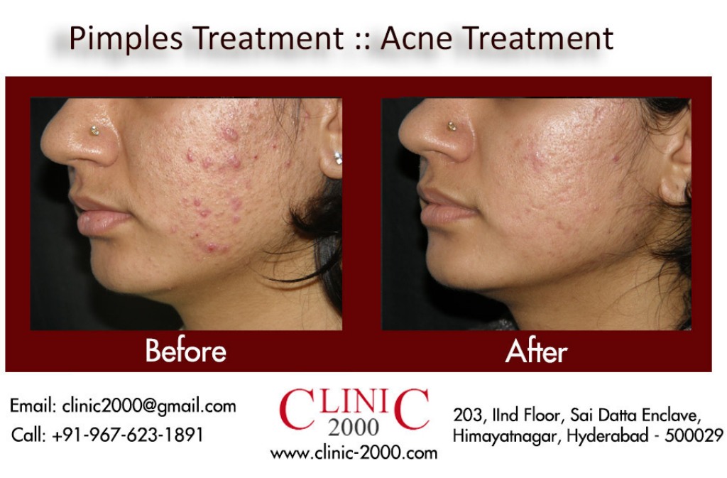 Reduce Acne at Clinic 2000