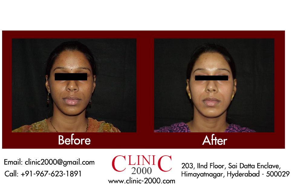 Complexion treatment for skin in Hyderabad