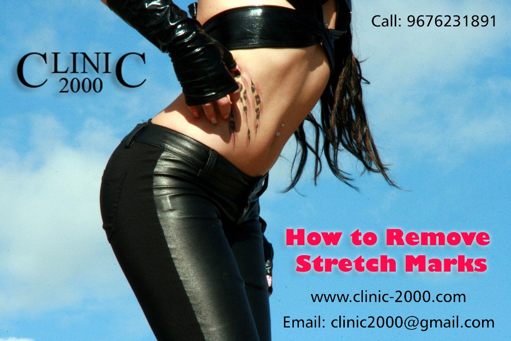 How to Remove Stretch Marks