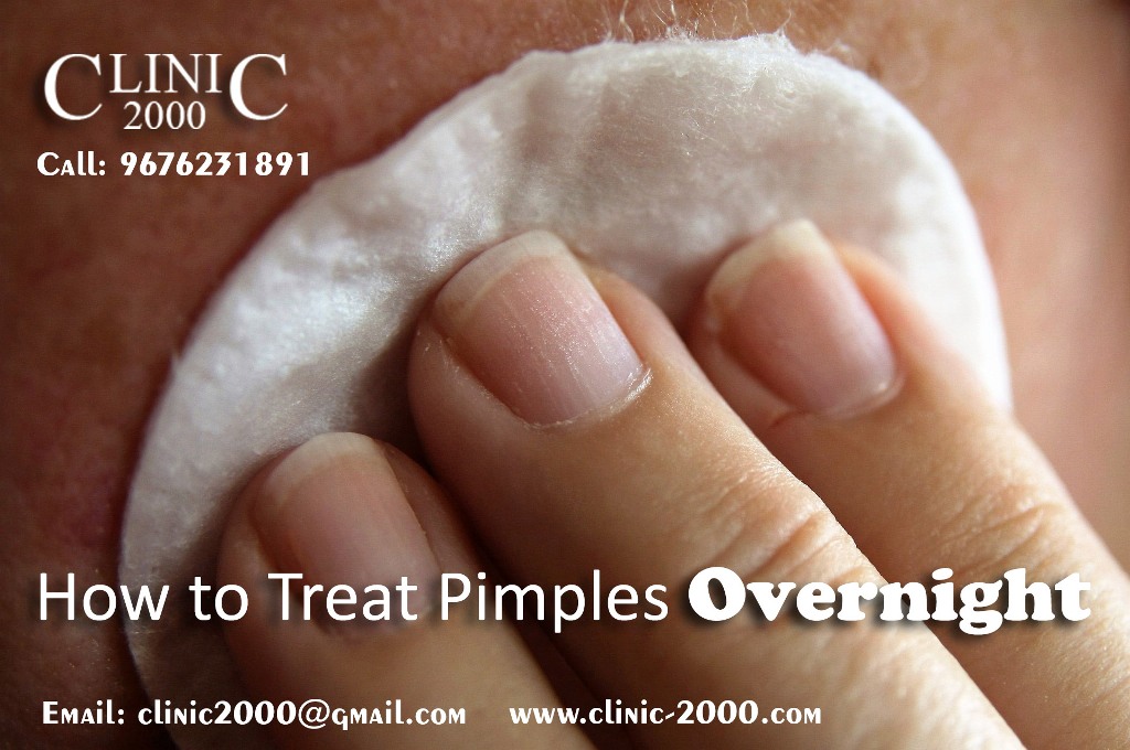 How to treat pimples overnight