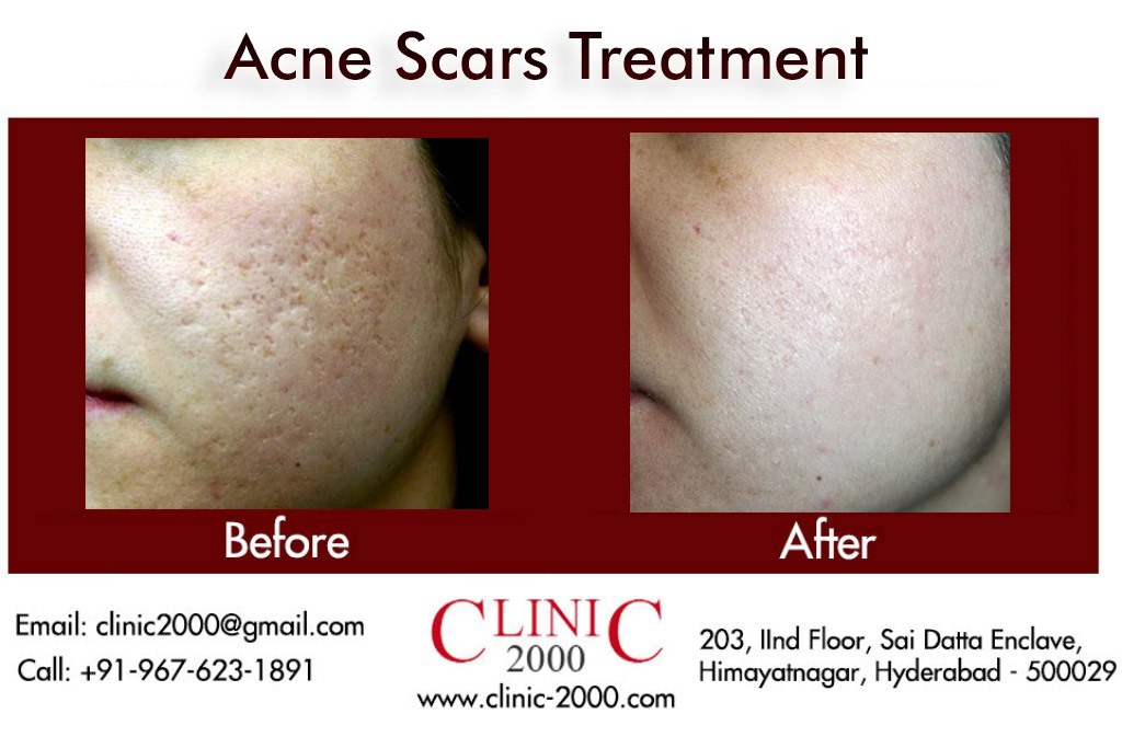 Reduce Acne at Clinic 2000