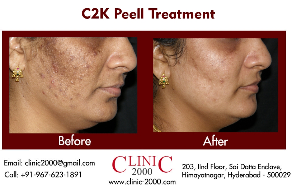 Chemical Peel Treatment in Hyderabad