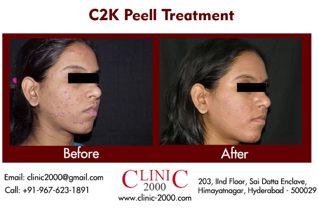 Best Chemical peel Treatment in Hyderabad