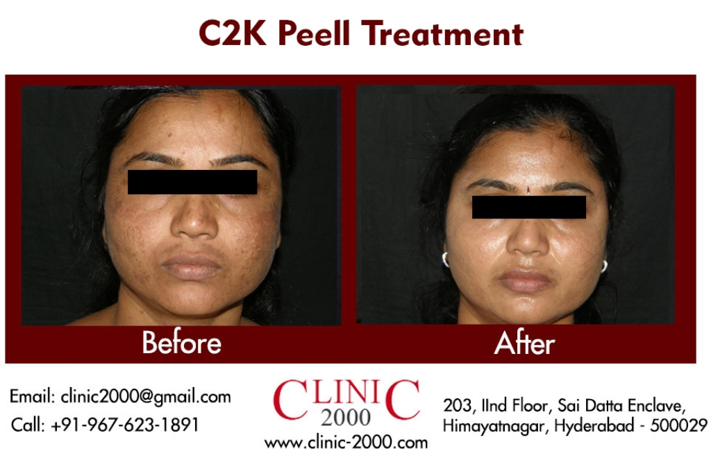 Chemical peel Treatment at Clinic 2000