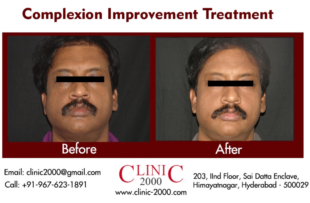 Treatment for Complexion improvement at clinic 2000