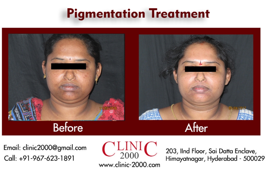 Best pigmentation Treatment in Hyderabad