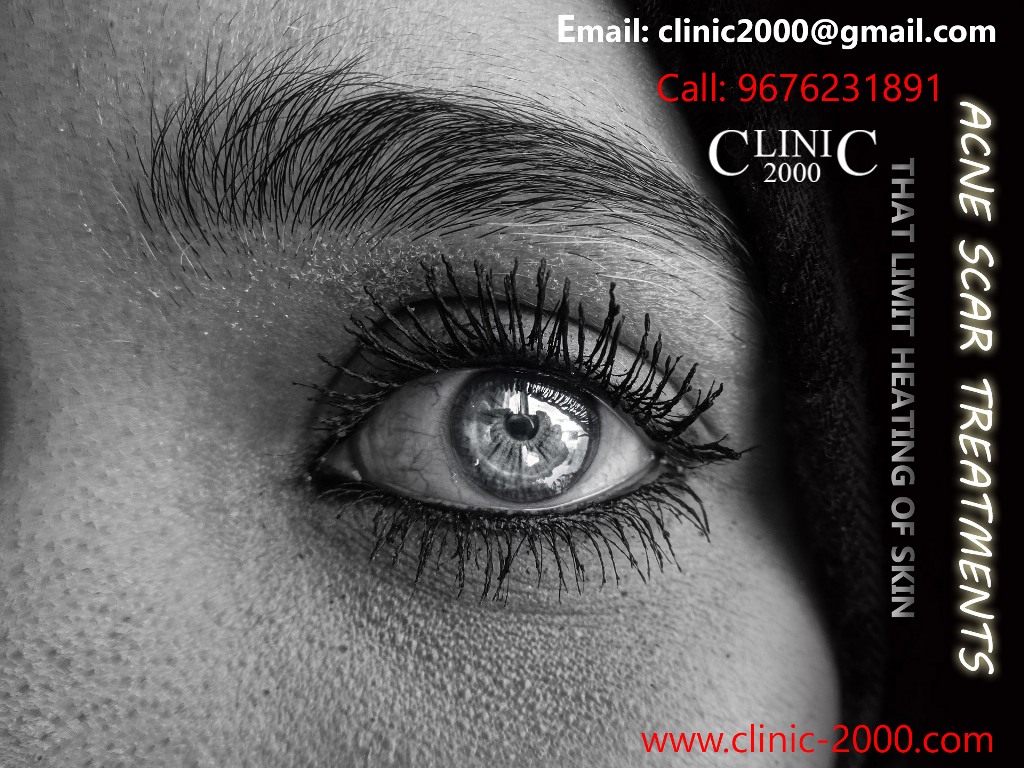 Remove unwanted Acne at Clinic 2000