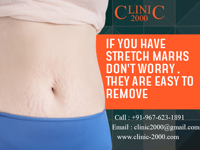 Remove Strech Marks in Clinic2000