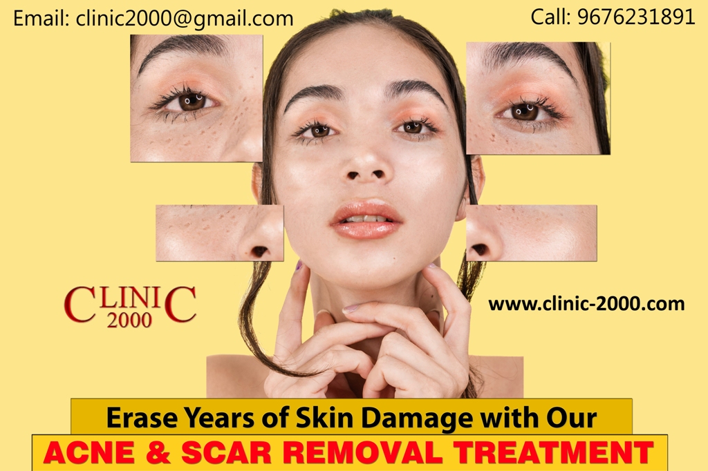 Remove Acne Scars with Professional Treatments in Hyderabad