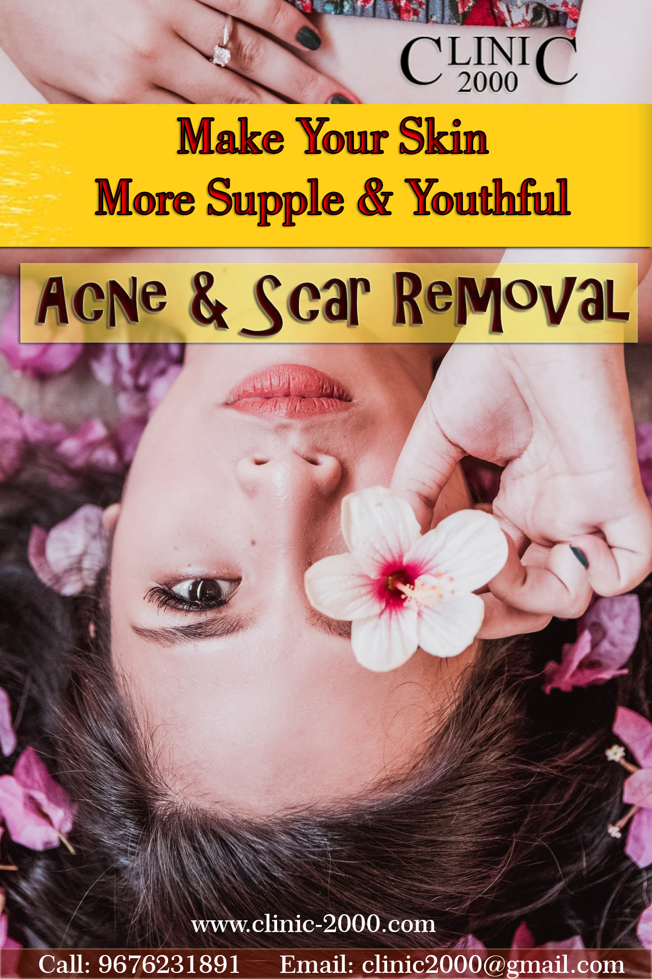 Best Acne Scar Removal Treatment in Hyderabad
