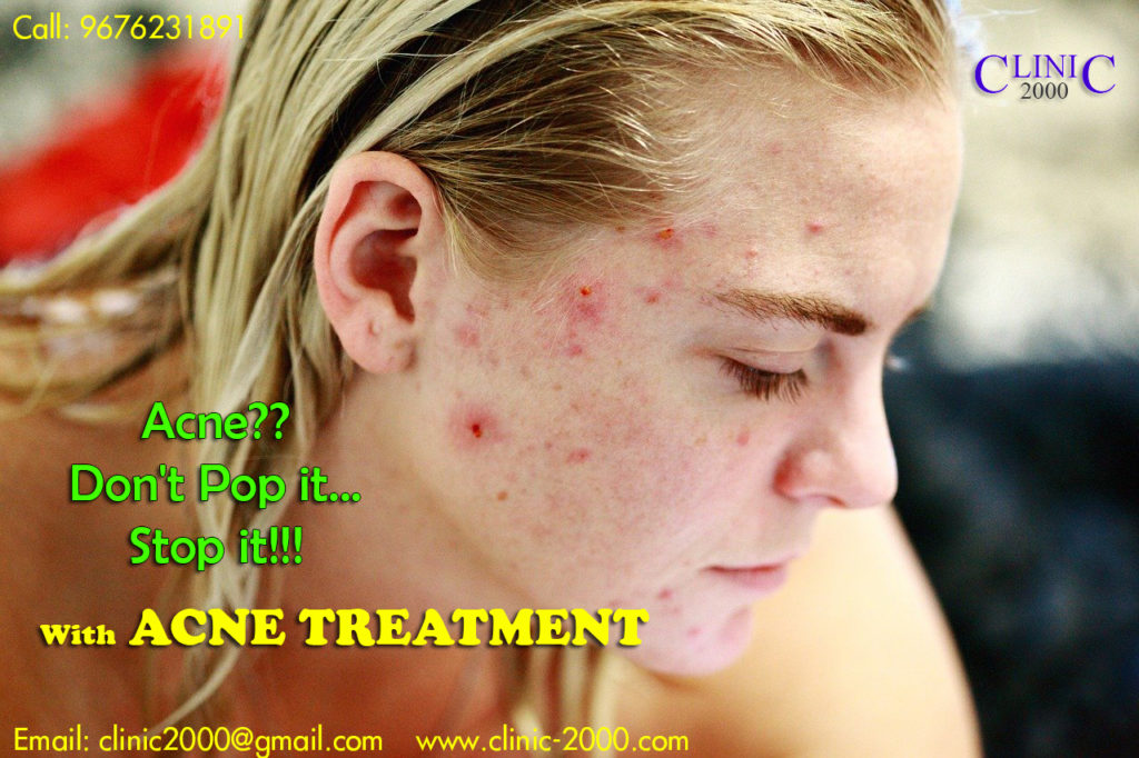 Best Acne Treatment Clinic in Hyderabad - Clinic 2000