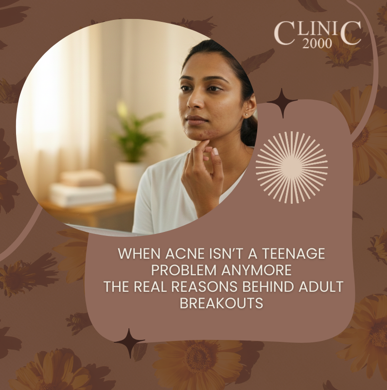 Adult Acne Explained – Why Breakouts Start After 25 – Clinic 2000