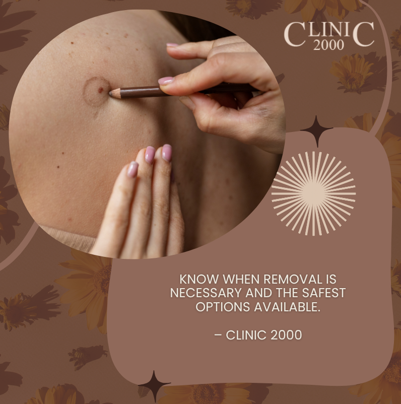 Warts, Moles, and Skin Tags: When to Remove Them and How It’s Done