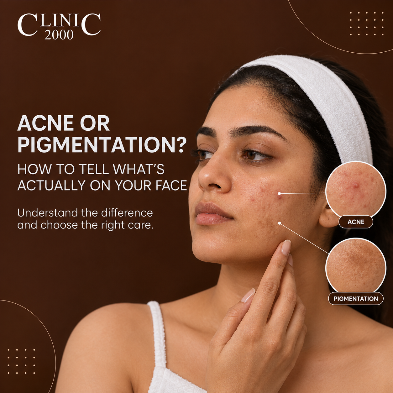 Acne or Pigmentation? How to Tell What’s Actually on Your Face