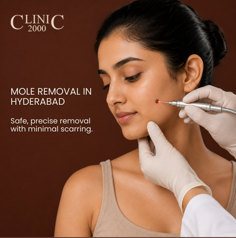 Mole Removal in Hyderabad: Safe, Scar- Free & Everything You Should Know Before and After