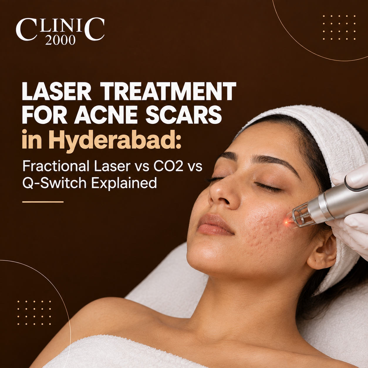 Laser Treatment for Acne Scars in Hyderabad: Fractional Laser vs CO2 vs Q-Switch Explained